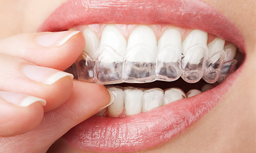 teeth whitening at corstorphine dental